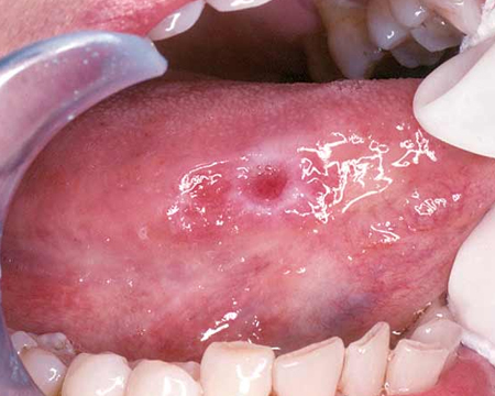 Oral Cancer Detection